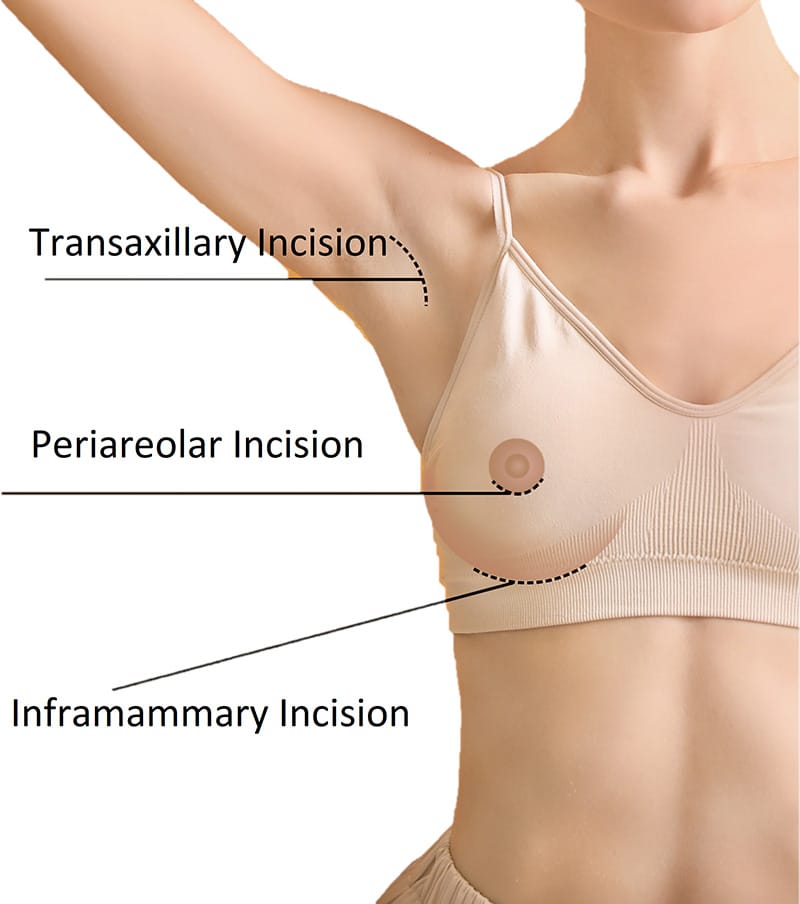 Breast Implant Incision Types