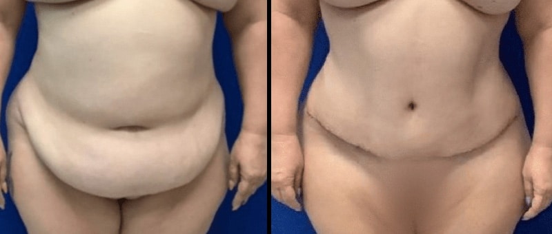 Liposuction Before and After Las Vegas