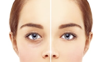 qualify for eyelid surgery